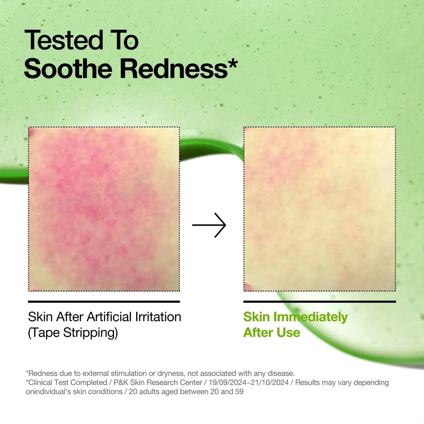 ANUA Azelaic Acid 10% Hyaluron Redness Soothing Serum – Redness Relief, Hydration & Blemish - Calming Serum | Korean Skincare - Amora Skin